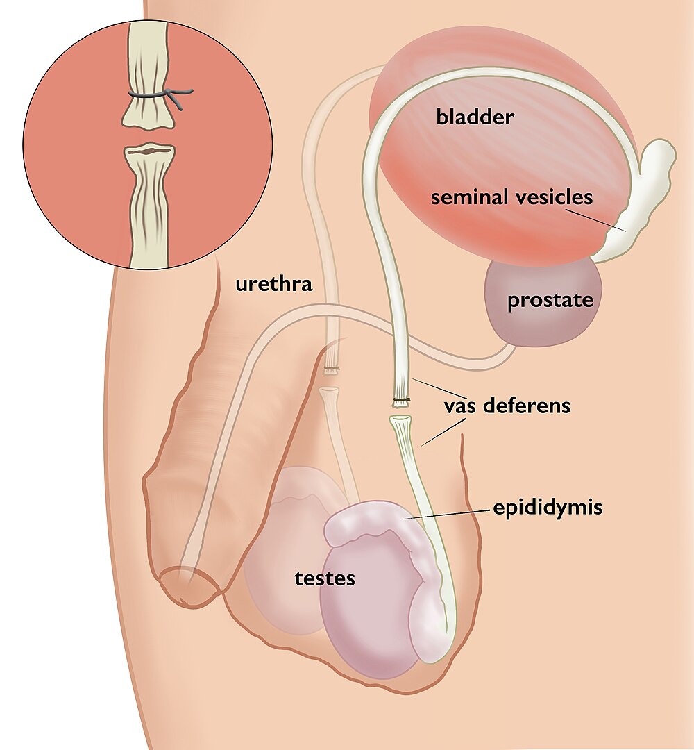 1000px-Open_Vasectomy_
